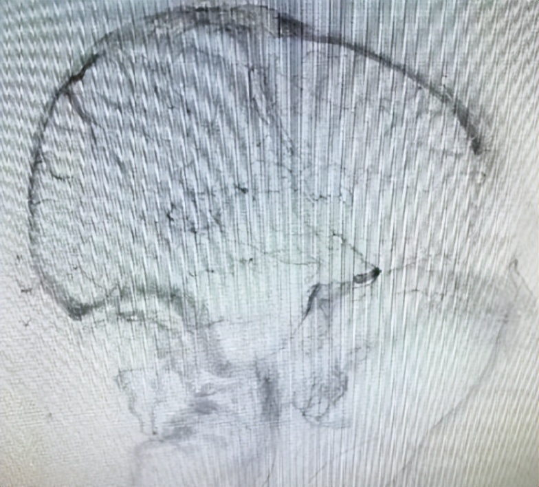 重症监护室救活孕妇故事,急救危急重症孕产妇途中分娩