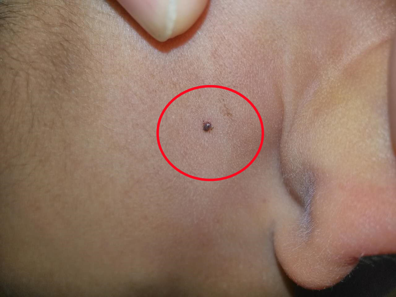 被蜱虫咬后死亡的几率有多大,夺命蜱虫怎么去除