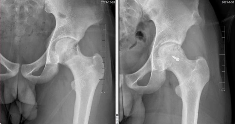儿童股骨头坏死痊愈后能踢足球吗,踢足球导致股骨头坏死