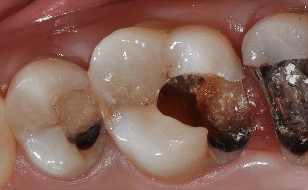 烂牙残根不拔的危害大吗,有没有治坏牙的好方法
