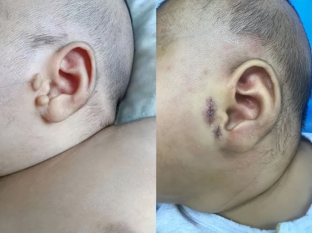 宝宝生出来小耳畸形医院有责任吗,先天性小耳畸形可以孕检出来吗