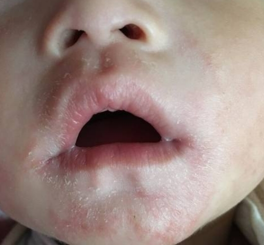 含有激素的面霜有哪些品牌,含激素面霜推荐