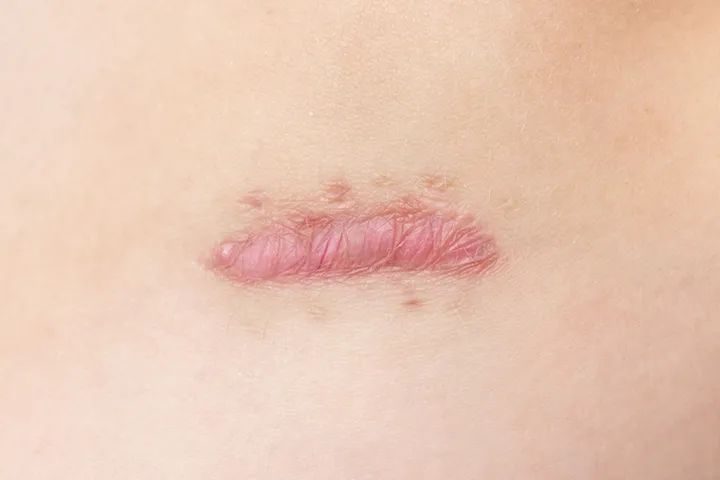 疤痕的治疗最佳时机,疤痕治疗方式根据哪些因素决定