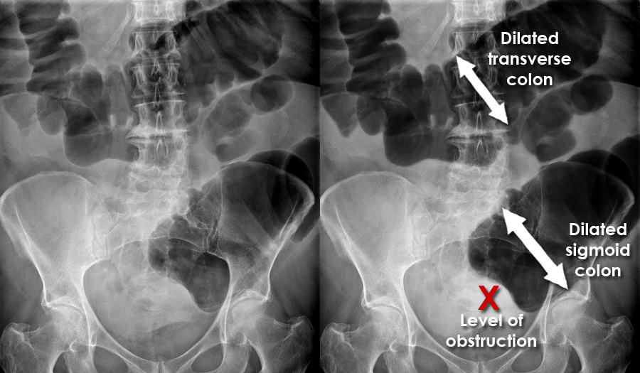 胎死腹中后孕妇有危险吗,最严重胎死腹中