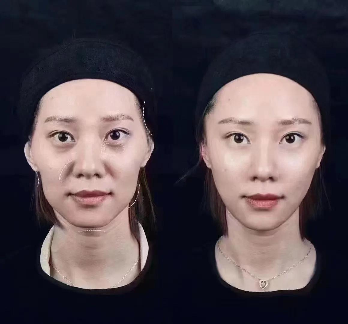 拉皮手术全过程要几个小时,拉皮手术哪家医院好