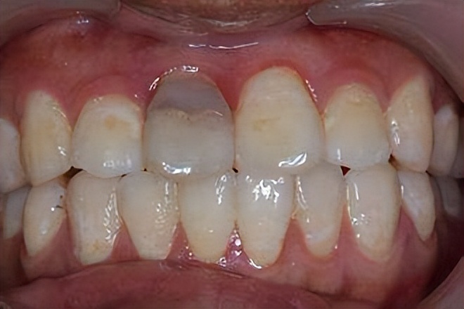 牙齿变深褐色是什么原因,牙齿变成灰褐色咋解决