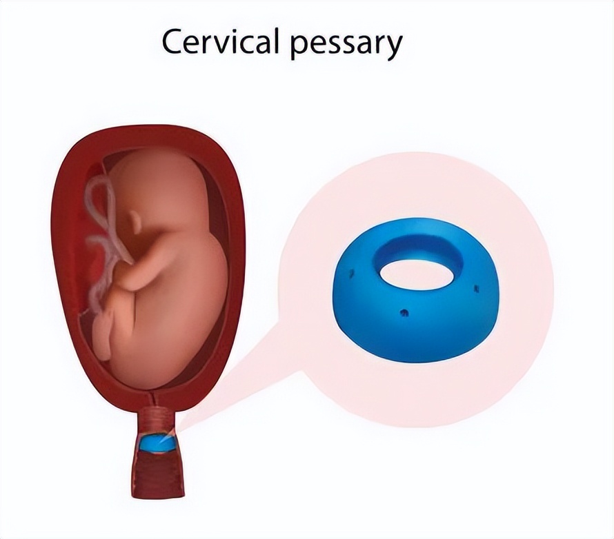 【科普】孕妈子宫“掉”到阴道口!备孕二胎,这件事一定要做