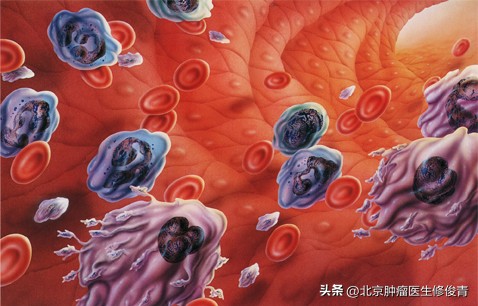 突然出现贫血症状是癌症的表现吗,癌症晚期贫血严重还要继续化疗吗