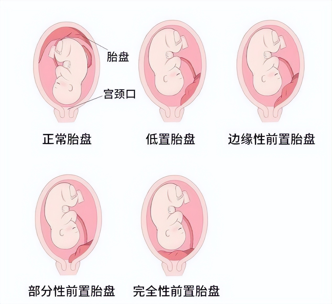 科普怀孕初期要注意什么,胎盘前置是什么意思需要注意什么