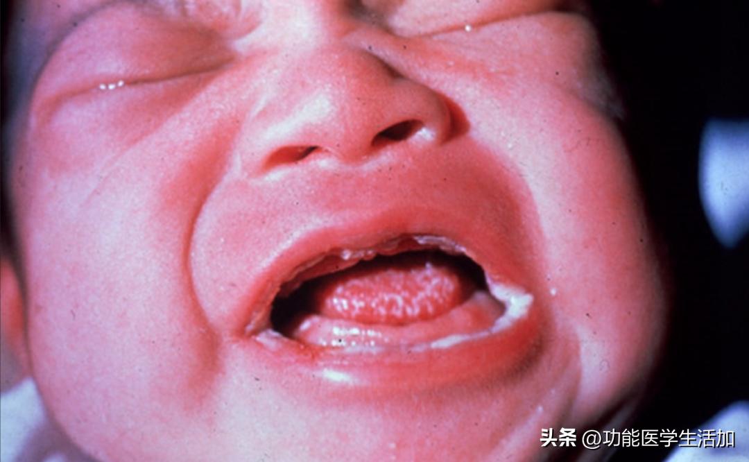 一文读懂念珠菌过度生长