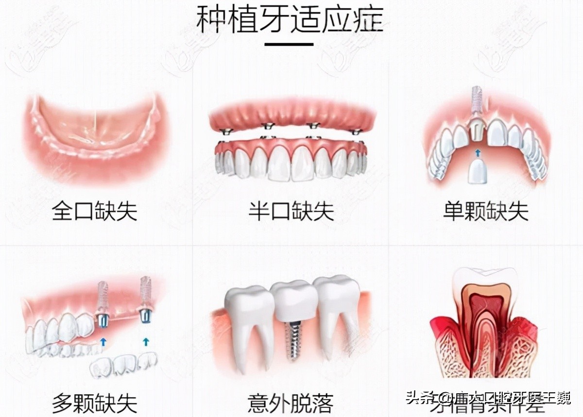 老年人种牙一般可以保持多久,老年人种牙好还是义齿修复好