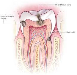 洗完牙后牙齿敏感酸痛正常吗,镶完牙以后牙齿特别敏感怎么回事