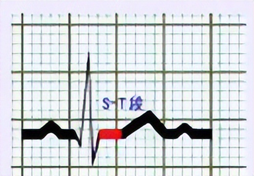 扩张型心肌病之科普小问答四,扩张型心肌病之科普四