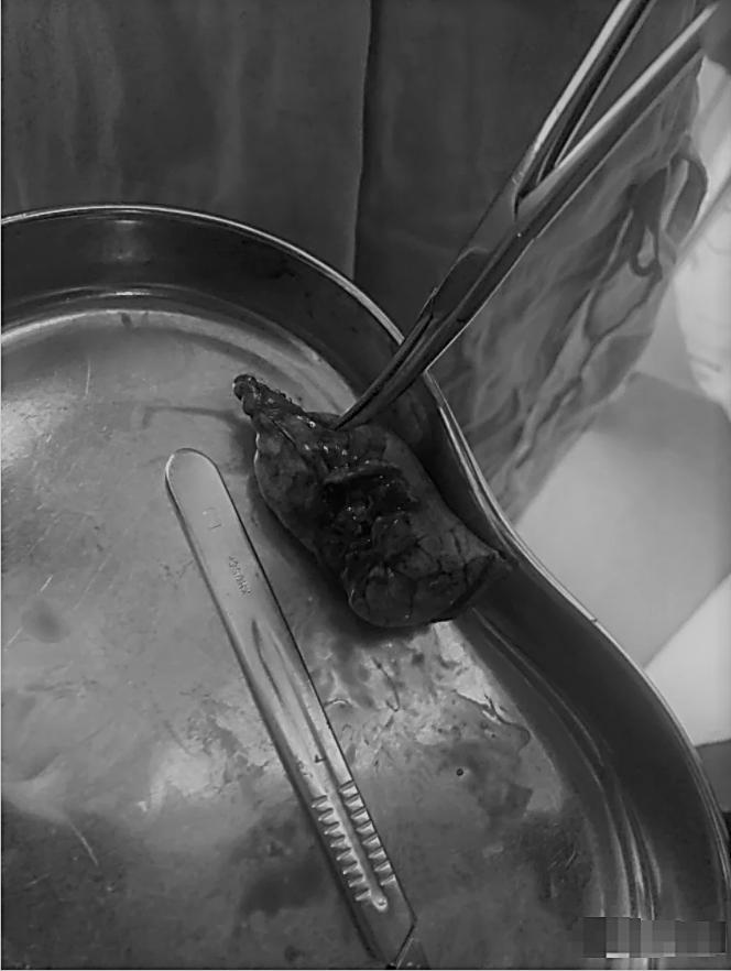 老公肺癌治好了,老公确诊肺癌2年