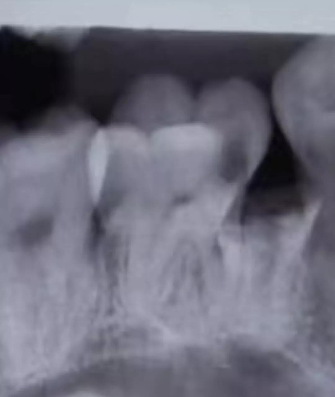 拔牙补牙多少钱以上才能医保报销,拔牙之后需要注意什么事项