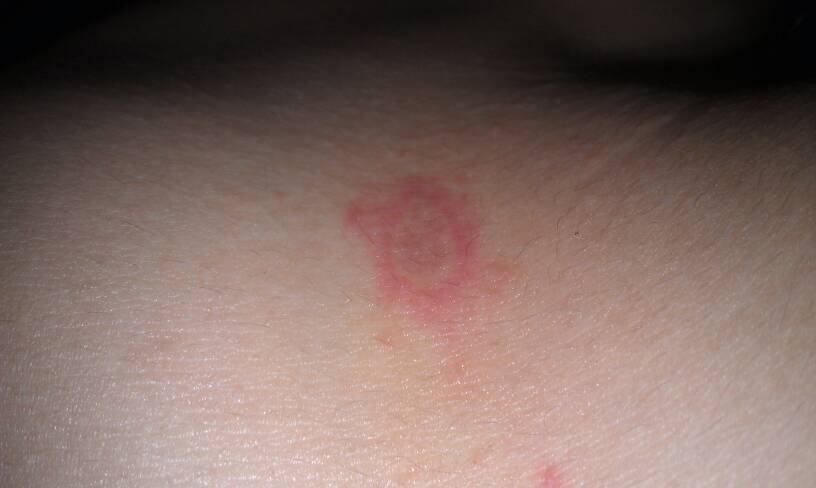 怎样知道股癣已根治,股癣和体癣怎么治疗最好