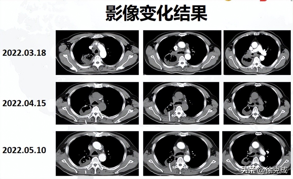 肺癌电场疗法,肺癌吸入疗法
