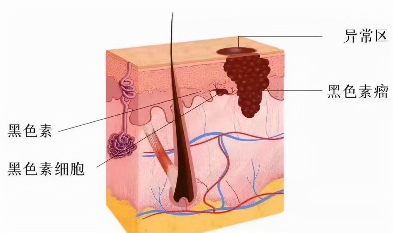 老人脚后跟长黑色素瘤,脚后跟长了一颗恶性黑色素瘤