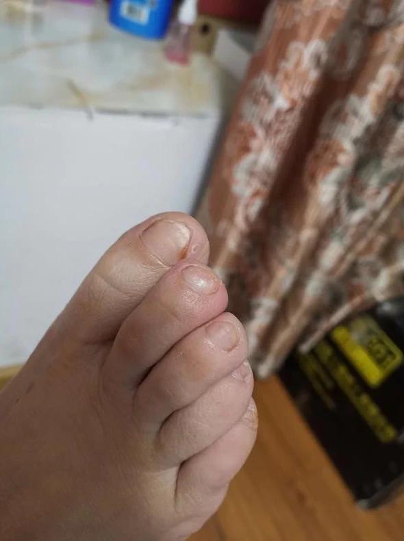 临汾十元根除灰指甲,拔掉灰指甲能根除吗