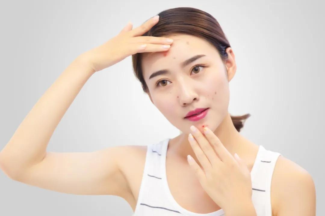 护肤小技巧痘印怎么去除,脸上痘痘痘印反反复复如何护肤