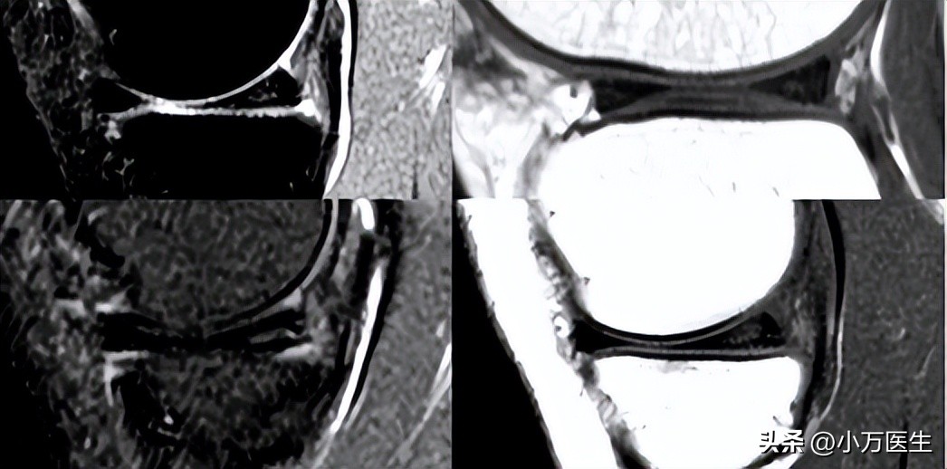 半月板后角撕裂微创手术,半月板撕裂分型