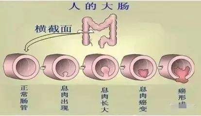 肠长了息肉会有啥症状,肠内为什么容易长息肉