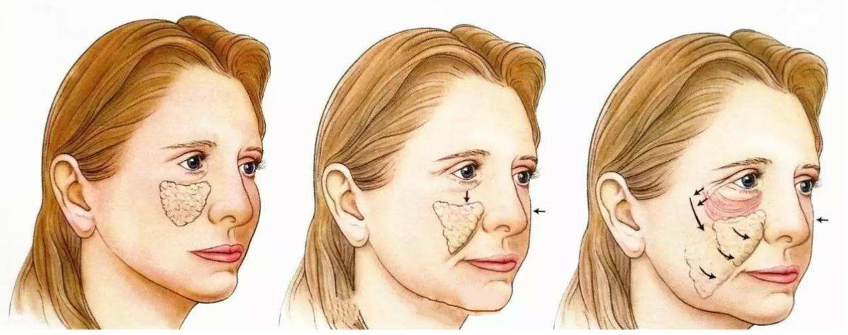 面部平整度是什么意思,怎样提高面部平整度