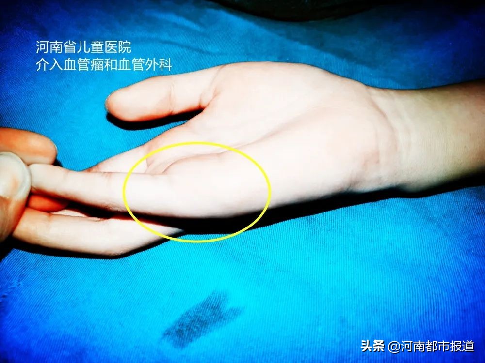 会跳动的手指,大拇指弯曲会自动抖动是什么病