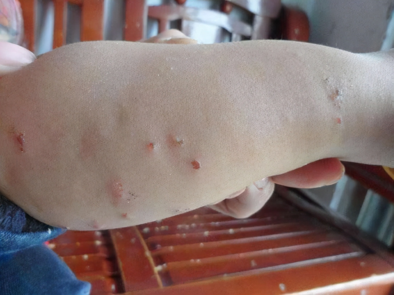 草坪虫子咬红肿硬块,草坪被虫子咬肿了怎么办