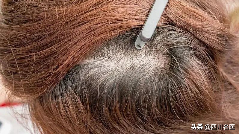 头发干燥白发多是缺啥营养,白发脱发缺乏什么营养元素