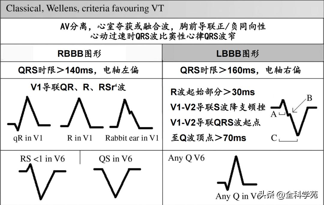 心电图上表现为宽qrs波,心电图中qrs是代表心动过速吗
