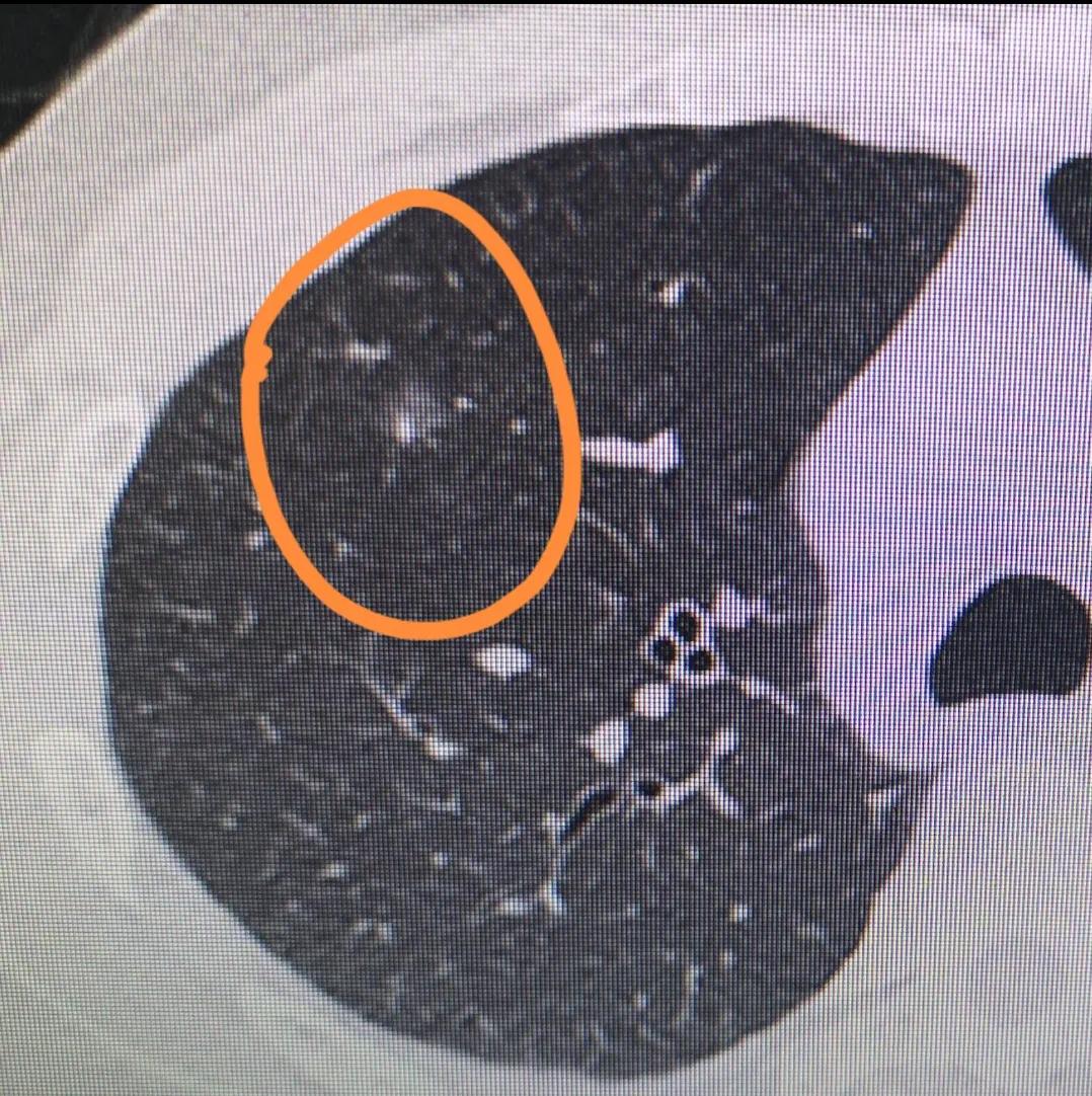 肺结节怎么解决,呼吸科与胸外科看肺结节哪个准