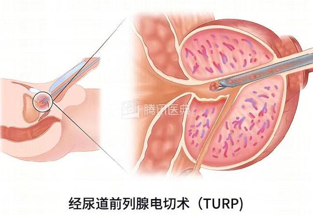 尿频尿急真的看不好吗,尿频尿急夜尿多千万别轻视