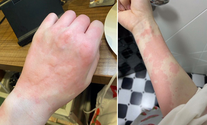 麻疹高发季怎么防控,荨麻疹换季导致全身发痒