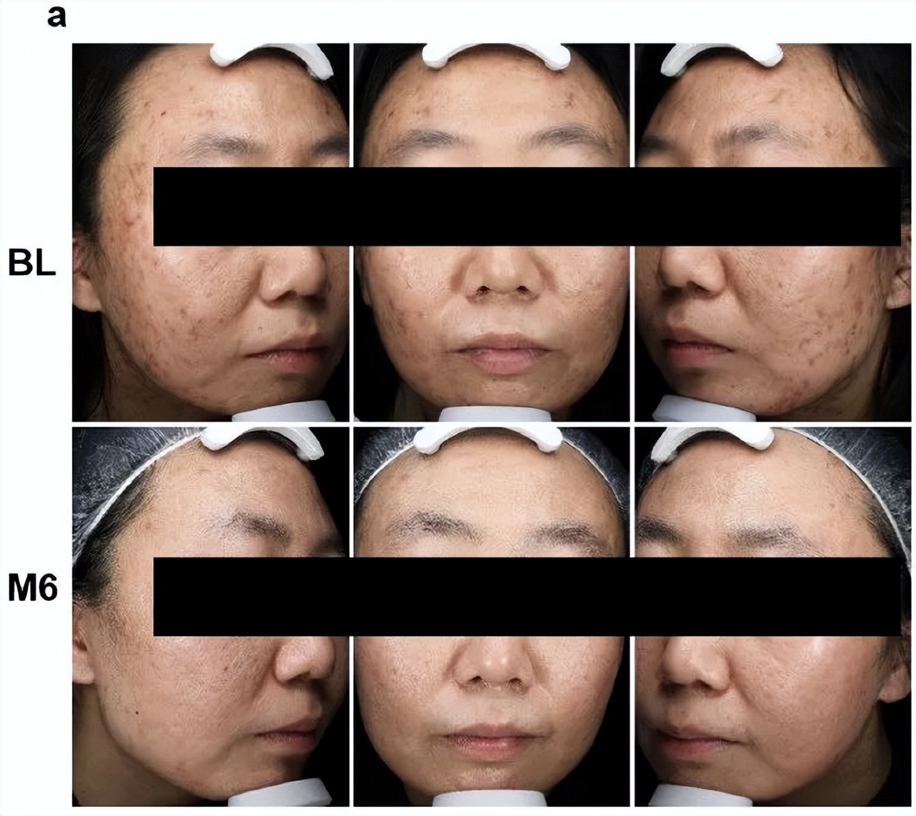 黄金微针能永久收毛孔吗,黄金微针是不是越肿效果越好