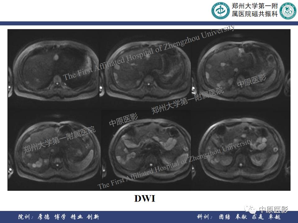肝脏血管瘤样本,正确认识肝脏血管瘤文章