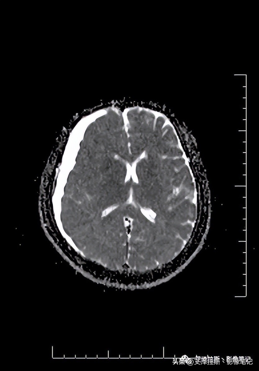 中枢性低通气综合征,中枢性低通气综合征可以治愈吗