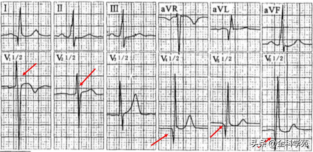 心电图qrs间期变长是怎样造成的,心电图qrs振幅多少是正常范围