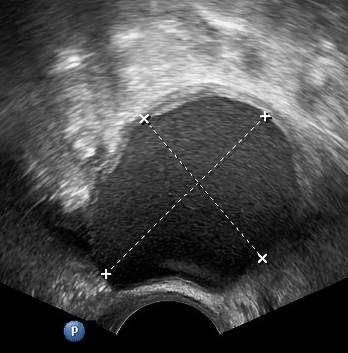 超声显示子宫肌瘤卵巢囊肿,显微镜下的卵巢囊肿