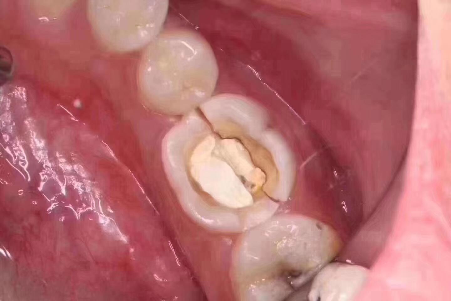 为什么要拔掉牙神经,拔掉牙神经有什么坏处