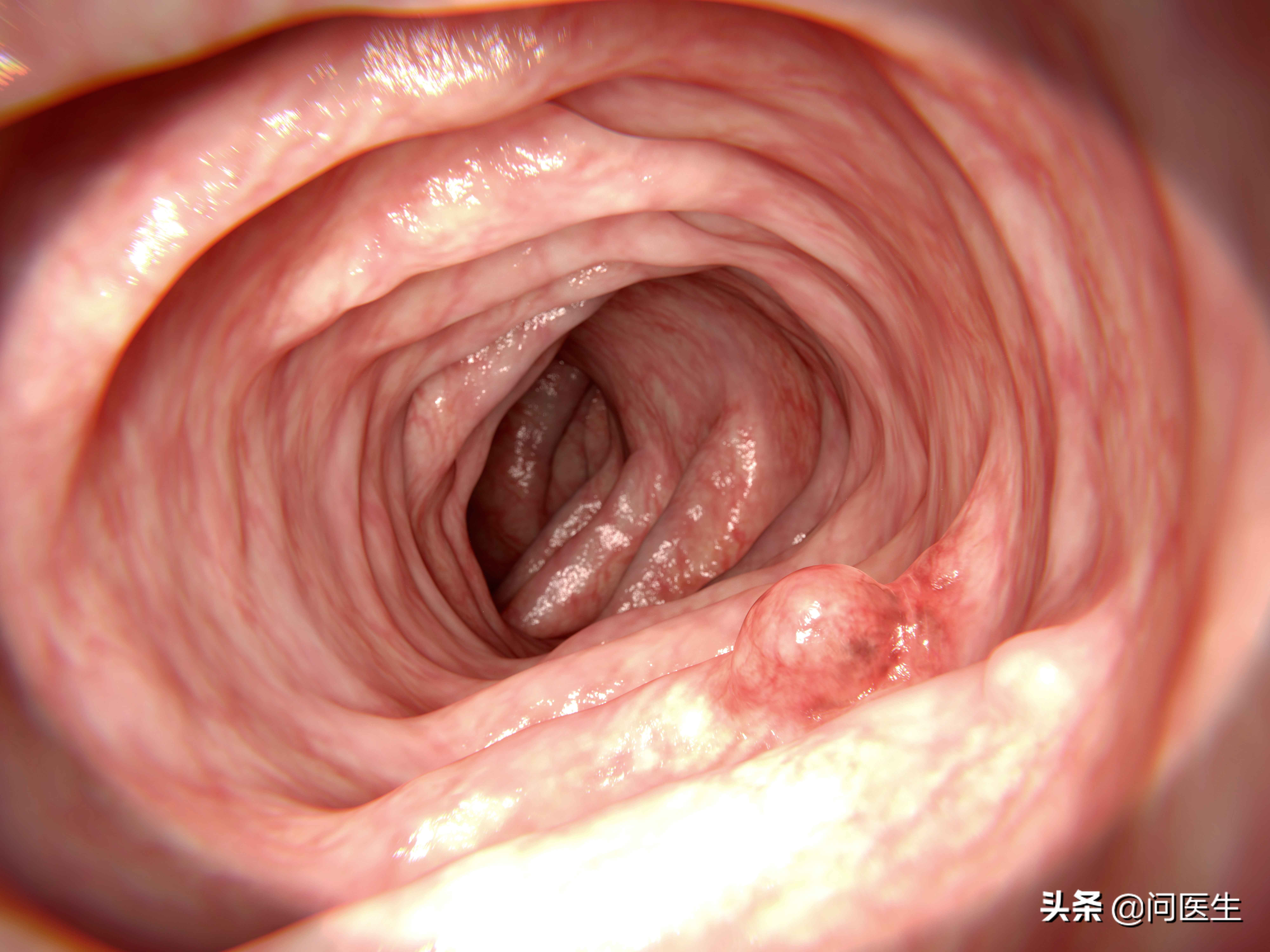 家人有肠息肉，亲属得肠癌的几率也会升高？