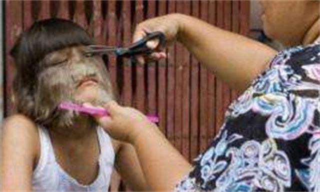 女生因为多毛症被歧视,身患多毛症