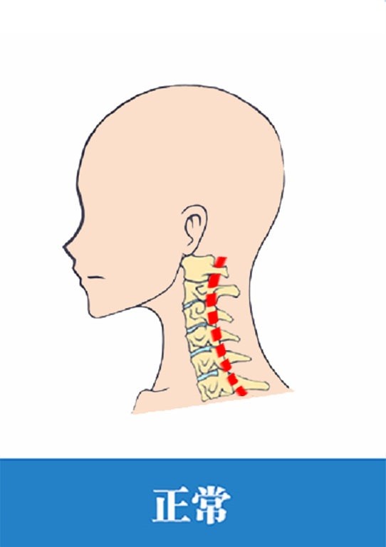 诊断颈椎曲度变直一年了能恢复吗,颈椎曲度变直又反弓如何恢复