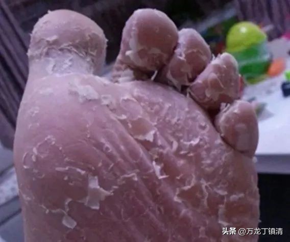 丁镇清从中西角度分析如何简单有效根治脚气病？