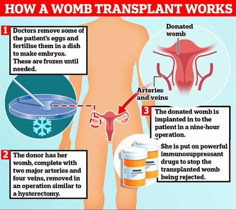 首例子宫移植,法国首例子宫移植