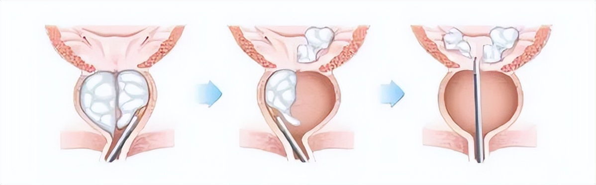 多年增生结节终于好了,前列腺增生好多年了能恢复正常吗