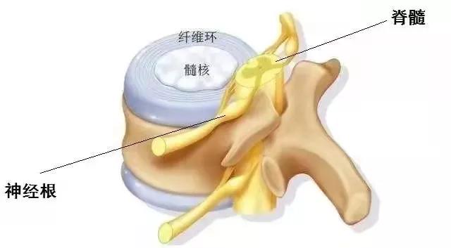 颈椎间盘突出压迫脊髓严重吗,颈椎压迫脊髓硬膜囊怎么办