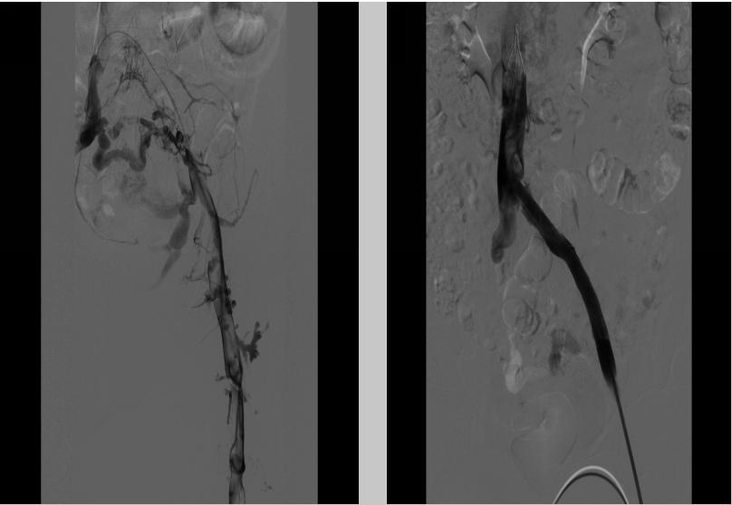 血管介入与介入穿刺的区别,让我们一起认识脑梗