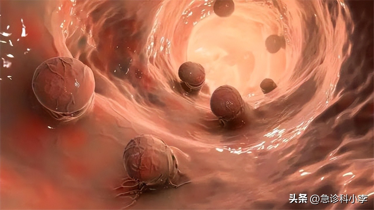 肠道为什么反复长息肉如何预防,如果肠道长息肉身体会有哪些反应