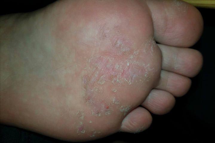 手足疣痊愈过程,跖疣治疗经验分享